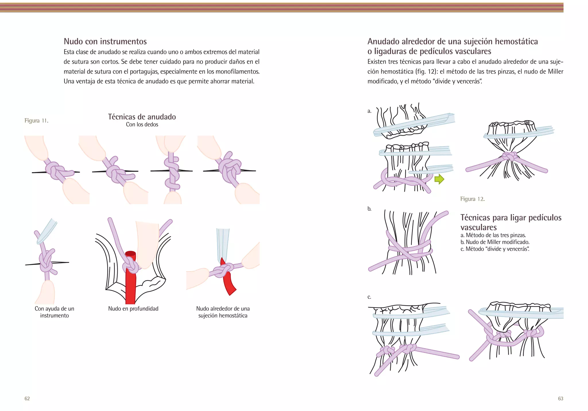 Nudo con instrumentos                                                                    Anudado alrededor de una sujeción hemostática
               Esta clase de anudado se realiza cuando uno o ambos extremos del material                o ligaduras de pedículos vasculares
               de sutura son cortos. Se debe tener cuidado para no producir daños en el                 Existen tres técnicas para llevar a cabo el anudado alrededor de una suje-
               material de sutura con el portagujas, especialmente en los monofilamentos.               ción hemostática (fig. 12): el método de las tres pinzas, el nudo de Miller
               Una ventaja de esta técnica de anudado es que permite ahorrar material.                  modificado, y el método “divide y vencerás”.



                                                                                                        a.
Figura 11.                     Técnicas de anudado
                                      Con los dedos




                                                                                                                                           Figura 12.
                                                                                                        b.
                                                                                                                                           Técnicas para ligar pedículos
                                                                                                                                           vasculares
                                                                                                                                           a. Método de las tres pinzas.
                                                                                                                                           b. Nudo de Miller modificado.
                                                                                                                                           c. Método “divide y vencerás”.




                                                                                                        c.
     Con ayuda de un           Nudo en profundidad               Nudo alrededor de una
       instrumento                                                sujeción hemostática




62                                                      Inicio                              Anterior
                                                                                             Anterior               Siguiente                                                   63
 