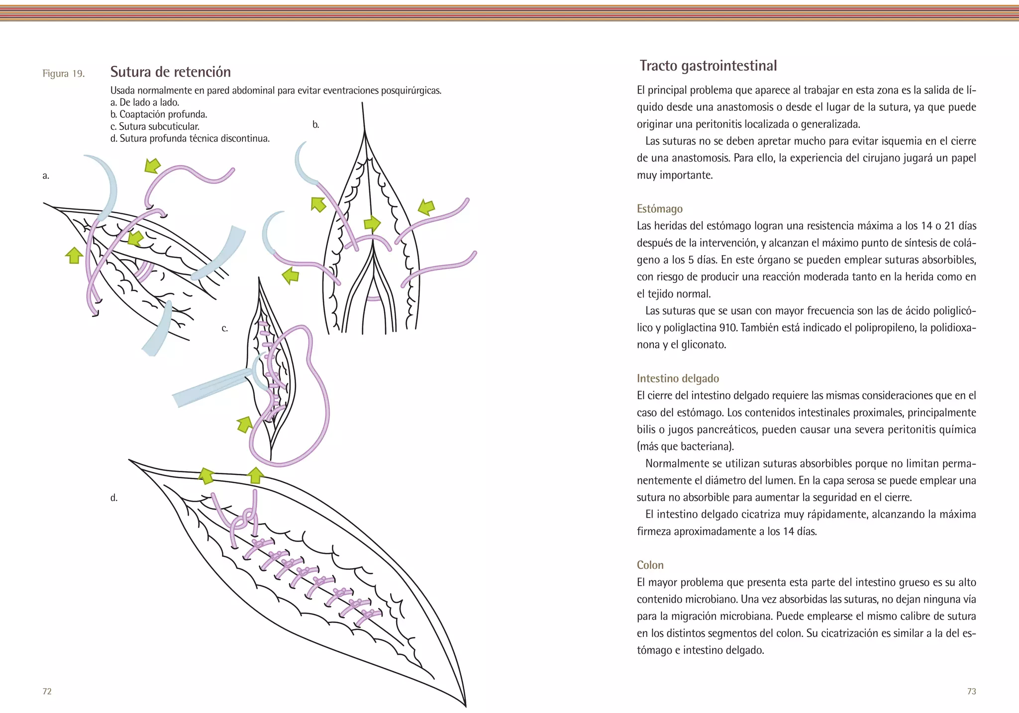 Figura 19.   Sutura de retención                                                                          Tracto gastrointestinal
             Usada normalmente en pared abdominal para evitar eventraciones posquirúrgicas.               El principal problema que aparece al trabajar en esta zona es la salida de lí-
             a. De lado a lado.                                                                           quido desde una anastomosis o desde el lugar de la sutura, ya que puede
             b. Coaptación profunda.
             c. Sutura subcuticular.                       b.                                             originar una peritonitis localizada o generalizada.
             d. Sutura profunda técnica discontinua.                                                        Las suturas no se deben apretar mucho para evitar isquemia en el cierre
                                                                                                          de una anastomosis. Para ello, la experiencia del cirujano jugará un papel
a.                                                                                                        muy importante.

                                                                                                          Estómago
                                                                                                          Las heridas del estómago logran una resistencia máxima a los 14 o 21 días
                                                                                                          después de la intervención, y alcanzan el máximo punto de síntesis de colá-
                                                                                                          geno a los 5 días. En este órgano se pueden emplear suturas absorbibles,
                                                                                                          con riesgo de producir una reacción moderada tanto en la herida como en
                                                                                                          el tejido normal.
                                                                                                             Las suturas que se usan con mayor frecuencia son las de ácido poliglicó-
                                       c.                                                                 lico y poliglactina 910. También está indicado el polipropileno, la polidioxa-
                                                                                                          nona y el gliconato.

                                                                                                          Intestino delgado
                                                                                                          El cierre del intestino delgado requiere las mismas consideraciones que en el
                                                                                                          caso del estómago. Los contenidos intestinales proximales, principalmente
                                                                                                          bilis o jugos pancreáticos, pueden causar una severa peritonitis química
                                                                                                          (más que bacteriana).
                                                                                                             Normalmente se utilizan suturas absorbibles porque no limitan perma-
                                                                                                          nentemente el diámetro del lumen. En la capa serosa se puede emplear una
             d.                                                                                           sutura no absorbible para aumentar la seguridad en el cierre.
                                                                                                             El intestino delgado cicatriza muy rápidamente, alcanzando la máxima
                                                                                                          firmeza aproximadamente a los 14 días.

                                                                                                          Colon
                                                                                                          El mayor problema que presenta esta parte del intestino grueso es su alto
                                                                                                          contenido microbiano. Una vez absorbidas las suturas, no dejan ninguna vía
                                                                                                          para la migración microbiana. Puede emplearse el mismo calibre de sutura
                                                                                                          en los distintos segmentos del colon. Su cicatrización es similar a la del es-
                                                                                                          tómago e intestino delgado.


72                                                       Inicio                               Anterior
                                                                                               Anterior               Siguiente                                                      73
 