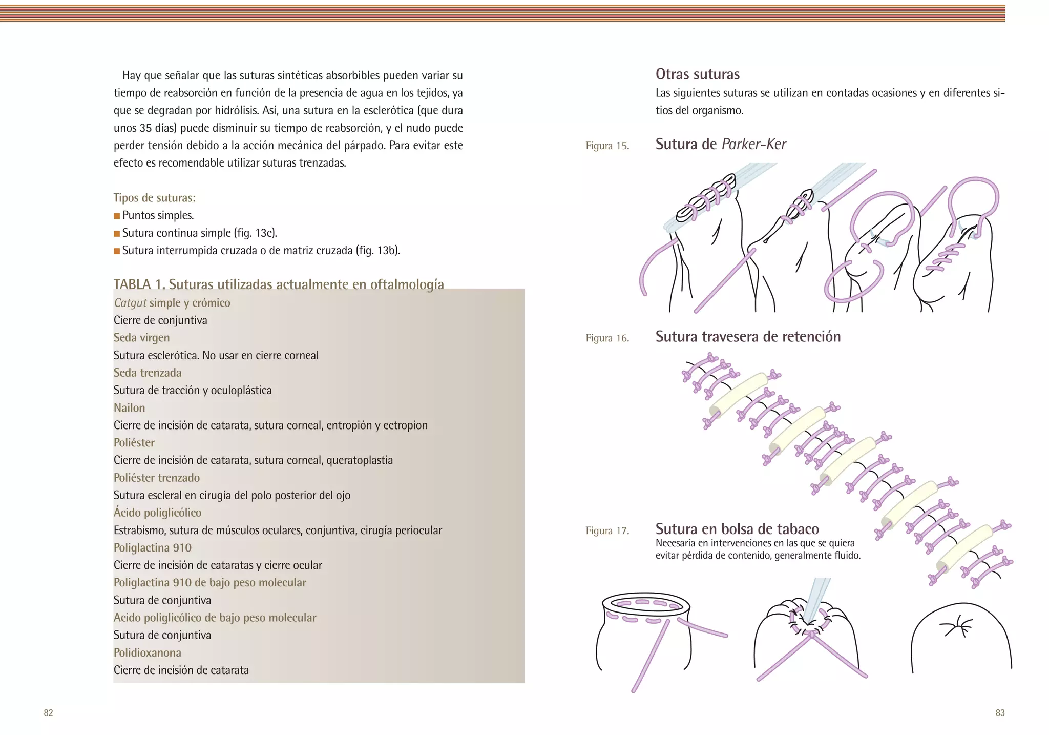 Hay que señalar que las suturas sintéticas absorbibles pueden variar su                    Otras suturas
     tiempo de reabsorción en función de la presencia de agua en los tejidos, ya                  Las siguientes suturas se utilizan en contadas ocasiones y en diferentes si-
     que se degradan por hidrólisis. Así, una sutura en la esclerótica (que dura                  tios del organismo.
     unos 35 días) puede disminuir su tiempo de reabsorción, y el nudo puede
     perder tensión debido a la acción mecánica del párpado. Para evitar este      Figura 15.     Sutura de Parker-Ker
     efecto es recomendable utilizar suturas trenzadas.

     Tipos de suturas:
     ■ Puntos simples.

     ■ Sutura continua simple (fig. 13c).

     ■ Sutura interrumpida cruzada o de matriz cruzada (fig. 13b).



     TABLA 1. Suturas utilizadas actualmente en oftalmología
     Catgut simple y crómico
     Cierre de conjuntiva
     Seda virgen                                                                   Figura 16.     Sutura travesera de retención
     Sutura esclerótica. No usar en cierre corneal
     Seda trenzada
     Sutura de tracción y oculoplástica
     Nailon
     Cierre de incisión de catarata, sutura corneal, entropión y ectropion
     Poliéster
     Cierre de incisión de catarata, sutura corneal, queratoplastia
     Poliéster trenzado
     Sutura escleral en cirugía del polo posterior del ojo
     Ácido poliglicólico
     Estrabismo, sutura de músculos oculares, conjuntiva, cirugía periocular       Figura 17.     Sutura en bolsa de tabaco
     Poliglactina 910                                                                             Necesaria en intervenciones en las que se quiera
                                                                                                  evitar pérdida de contenido, generalmente fluido.
     Cierre de incisión de cataratas y cierre ocular
     Poliglactina 910 de bajo peso molecular
     Sutura de conjuntiva
     Acido poliglicólico de bajo peso molecular
     Sutura de conjuntiva
     Polidioxanona
     Cierre de incisión de catarata


82                                                              Inicio                          Anterior
                                                                                                 Anterior                                                                  83
 