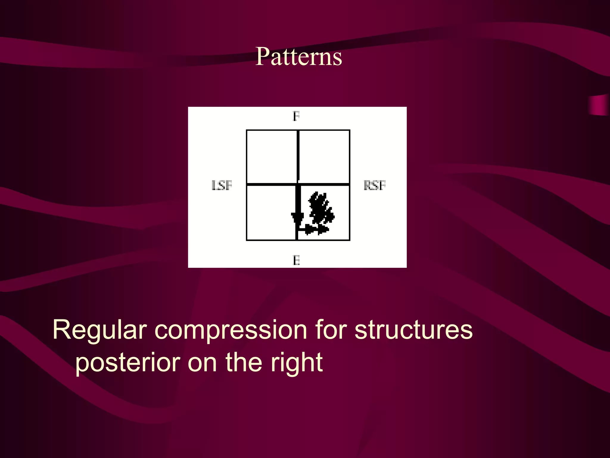 Patterns
Regular compression for structures
posterior on the right
 