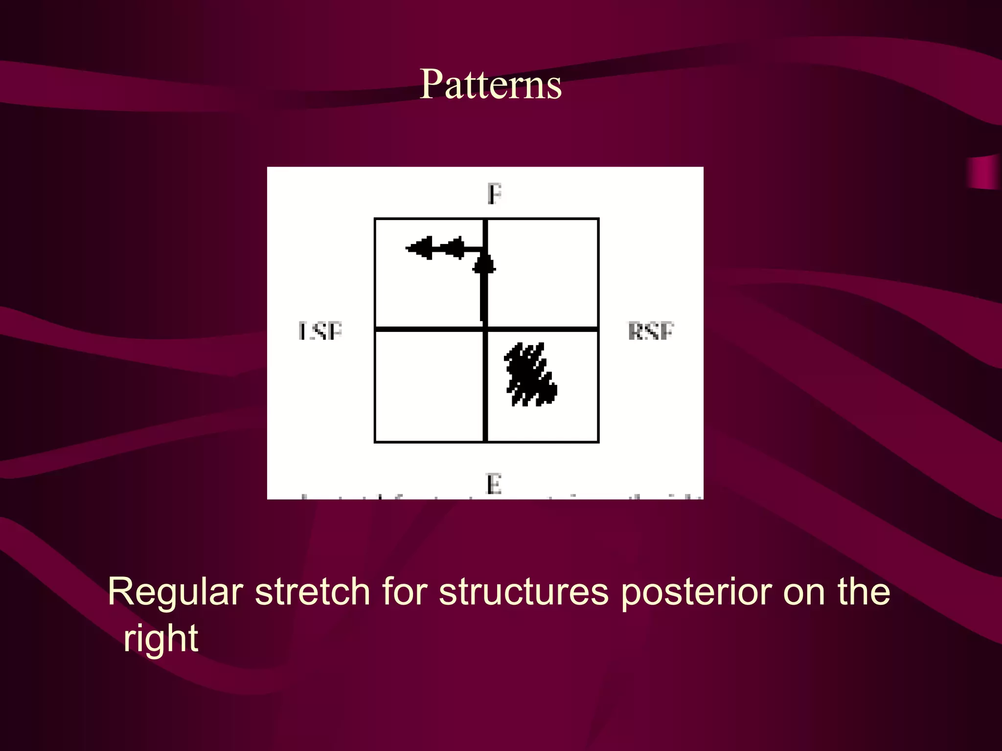 Patterns
Regular stretch for structures posterior on the
right
 