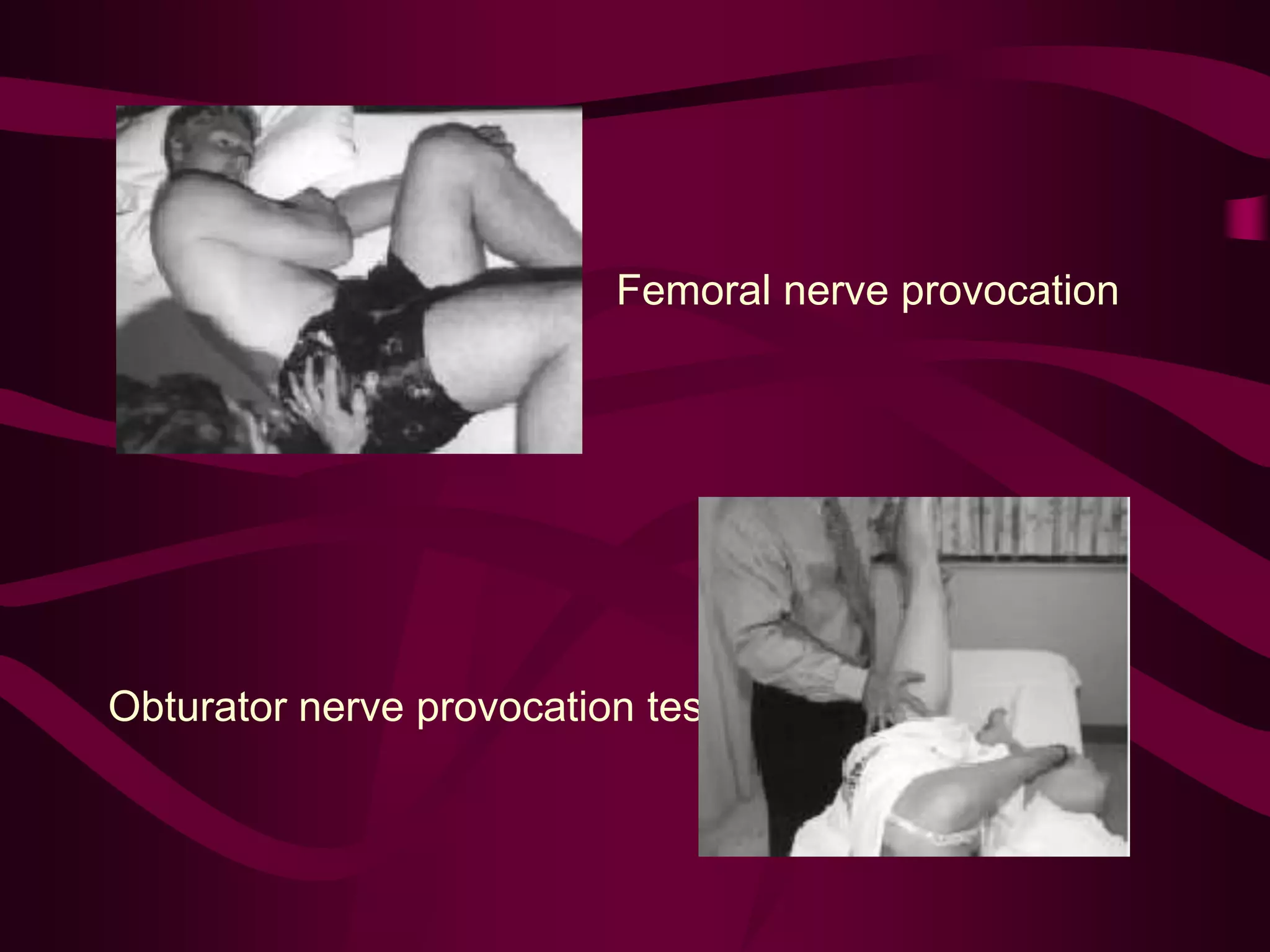 Femoral nerve provocation
test
Obturator nerve provocation test
 