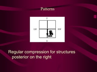 Patterns
Regular compression for structures
posterior on the right
 