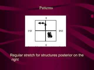 Patterns
Regular stretch for structures posterior on the
right
 
