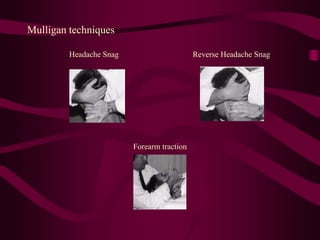 Mulligan techniques
Headache Snag Reverse Headache Snag
Forearm traction
 