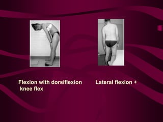 Flexion with dorsiflexion Lateral flexion +
knee flex
 