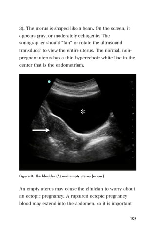 3). The uterus is shaped like a bean. On the screen, it
appears gray, or moderately echogenic. The
sonographer should fan or rotate the ultrasound
transducer to view the entire uterus. The normal, non-
pregnant uterus has a thin hyperechoic white line in the
center that is the endometrium.




Figure 3. The bladder (*) and empty uterus (arrow)


An empty uterus may cause the clinician to worry about
an ectopic pregnancy. A ruptured ectopic pregnancy
blood may extend into the abdomen, so it is important


                                                          107
 