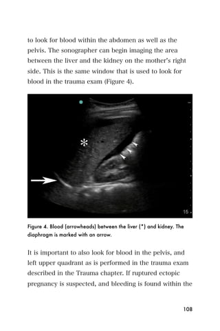 to look for blood within the abdomen as well as the
pelvis. The sonographer can begin imaging the area
between the liver and the kidney on the mother s right
side. This is the same window that is used to look for
blood in the trauma exam (Figure 4).




Figure 4. Blood (arrowheads) between the liver (*) and kidney. The
diaphragm is marked with an arrow.


It is important to also look for blood in the pelvis, and
left upper quadrant as is performed in the trauma exam
described in the Trauma chapter. If ruptured ectopic
pregnancy is suspected, and bleeding is found within the



                                                                 108
 