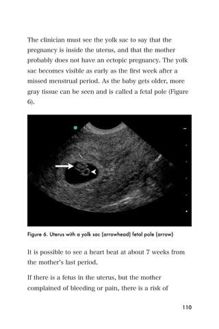 The clinician must see the yolk sac to say that the
pregnancy is inside the uterus, and that the mother
probably does not have an ectopic pregnancy. The yolk
sac becomes visible as early as the ﬁrst week after a
missed menstrual period. As the baby gets older, more
gray tissue can be seen and is called a fetal pole (Figure
6).




Figure 6. Uterus with a yolk sac (arrowhead) fetal pole (arrow)


It is possible to see a heart beat at about 7 weeks from
the mother s last period.

If there is a fetus in the uterus, but the mother
complained of bleeding or pain, there is a risk of


                                                                  110
 