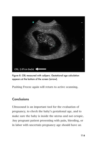 Figure 8. CRL measured with calipers. Gestational age calculation
appears at the bottom of the screen (arrow).


Pushing Freeze again will return to active scanning.



Conclusions

Ultrasound is an important tool for the evaluation of
pregnancy, to check the baby s gestational age, and to
make sure the baby is inside the uterus and not ectopic.
Any pregnant patient presenting with pain, bleeding, or
in labor with uncertain pregnancy age should have an


                                                                    114
 