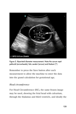 Figure 2. Biparietal diameter measurement. Note the cavum septi
pellucidi (arrowheads), falx cerebri (arrow) and thalami (*)


Remember to press the Save button after each
measurement to allow the machine to enter the data
into the grand calculation for gestational age.


Head circumference

For Head Circumference (HC), the same frozen image
may be used, showing the fetal head with calvarium,
through the thalamus and third ventricle, and ideally the



                                                                  120
 