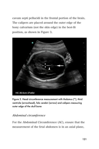 cavum septi pellucidi in the frontal portion of the brain.
The calipers are placed around the outer edge of the
bony calvarium (not the skin edge) in the best-ﬁt
position, as shown in Figure 3.




Figure 3. Head circumference measurement with thalamus (*), third
ventricle (arrowhead), falx cerebri (arrow) and calipers measuring
outer edge of the skull bone



Abdominal circumference

For the Abdominal Circumference (AC), ensure that the
measurement of the fetal abdomen is in an axial plane,



                                                                     121
 