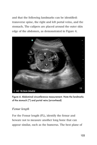 and that the following landmarks can be identiﬁed:
transverse spine, the right and left portal veins, and the
stomach. The calipers are placed around the outer skin
edge of the abdomen, as demonstrated in Figure 4.




Figure 4. Abdominal circumference measurement. Note the landmarks
of the stomach (*) and portal veins (arrowhead)


Femur length

For the Femur length (FL), identify the femur and
beware not to measure another long bone that can
appear similar, such as the humerus. The best plane of


                                                              122
 