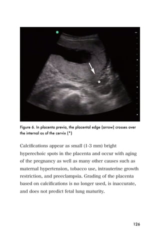 Figure 6. In placenta previa, the placental edge (arrow) crosses over
the internal os of the cervix (*)


Calciﬁcations appear as small (1-3 mm) bright
hyperechoic spots in the placenta and occur with aging
of the pregnancy as well as many other causes such as
maternal hypertension, tobacco use, intrauterine growth
restriction, and preeclampsia. Grading of the placenta
based on calciﬁcations is no longer used, is inaccurate,
and does not predict fetal lung maturity.




                                                                   126
 