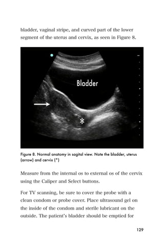 bladder, vaginal stripe, and curved part of the lower
segment of the uterus and cervix, as seen in Figure 8.




Figure 8. Normal anatomy in sagital view. Note the bladder, uterus
(arrow) and cervix (*)


Measure from the internal os to external os of the cervix
using the Caliper and Select buttons.

For TV scanning, be sure to cover the probe with a
clean condom or probe cover. Place ultrasound gel on
the inside of the condom and sterile lubricant on the
outside. The patient s bladder should be emptied for


                                                                 129
 