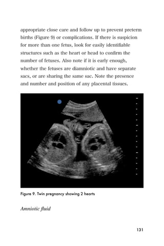 appropriate close care and follow up to prevent preterm
births (Figure 9) or complications. If there is suspicion
for more than one fetus, look for easily identiﬁable
structures such as the heart or head to conﬁrm the
number of fetuses. Also note if it is early enough,
whether the fetuses are diamniotic and have separate
sacs, or are sharing the same sac. Note the presence
and number and position of any placental tissues.




Figure 9. Twin pregnancy showing 2 hearts



Amniotic ﬂuid


                                                        131
 