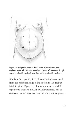 Figure 10. The gravid uterus is divided into four quadrants. The
mother’s upper left quadrant is number 1, lower left is number 2, right
upper quadrant is number 3 and right lower quadrant is number 4.


Amniotic ﬂuid pockets in each quadrant are measured
from the superﬁcial edge of the pocket to the deepest
fetal structure (Figure 11). The measurements added
together to produce the AFI. Oligohydramnios can be
deﬁned as an AFI less than 7-8 cm, while values greater




                                                                    133
 