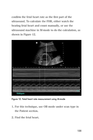 conﬁrm the fetal heart rate as the ﬁrst part of the
ultrasound. To calculate the FHR, either watch the
beating fetal heart and count manually, or use the
ultrasound machine in M-mode to do the calculation, as
shown in Figure 12.




Figure 12. Fetal heart rate measurement using M-mode


1. For this technique, use OB mode under scan type in
   the Patient section.

2. Find the fetal heart.




                                                       135
 