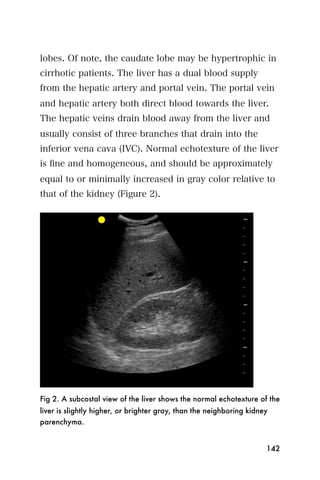 lobes. Of note, the caudate lobe may be hypertrophic in
cirrhotic patients. The liver has a dual blood supply
from the hepatic artery and portal vein. The portal vein
and hepatic artery both direct blood towards the liver.
The hepatic veins drain blood away from the liver and
usually consist of three branches that drain into the
inferior vena cava (IVC). Normal echotexture of the liver
is ﬁne and homogeneous, and should be approximately
equal to or minimally increased in gray color relative to
that of the kidney (Figure 2).




Fig 2. A subcostal view of the liver shows the normal echotexture of the
liver is slightly higher, or brighter gray, than the neighboring kidney
parenchyma.


                                                                      142
 