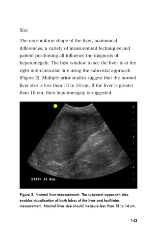 Size

The non-uniform shape of the liver, anatomical
diﬀerences, a variety of measurement techniques and
patient positioning all inﬂuence the diagnosis of
hepatomegaly. The best window to see the liver is at the
right mid-clavicular line using the subcostal approach
(Figure 2). Multiple prior studies suggest that the normal
liver size is less than 13 to 14 cm. If the liver is greater
than 16 cm, then hepatomegaly is suggested.




Figure 3. Normal liver measurement. The subcostal approach also
enables visualization of both lobes of the liver and facilitates
measurement. Normal liver size should measure less than 13 to 14 cm.



                                                                  143
 