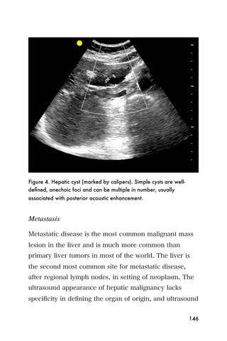 Figure 4. Hepatic cyst (marked by calipers). Simple cysts are well-
deﬁned, anechoic foci and can be multiple in number, usually
associated with posterior acoustic enhancement.



Metastasis

Metastatic disease is the most common malignant mass
lesion in the liver and is much more common than
primary liver tumors in most of the world. The liver is
the second most common site for metastatic disease,
after regional lymph nodes, in setting of neoplasm. The
ultrasound appearance of hepatic malignancy lacks
speciﬁcity in deﬁning the organ of origin, and ultrasound


                                                                      146
 