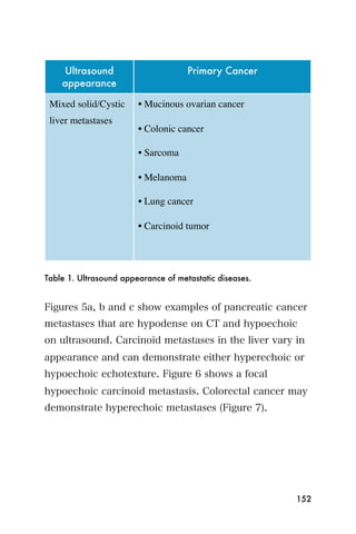 Ultrasound                       Primary Cancer
    appearance

 Mixed solid/Cystic     • Mucinous ovarian cancer
 liver metastases
                        • Colonic cancer

                        • Sarcoma

                        • Melanoma

                        • Lung cancer

                        • Carcinoid tumor




Table 1. Ultrasound appearance of metastatic diseases.


Figures 5a, b and c show examples of pancreatic cancer
metastases that are hypodense on CT and hypoechoic
on ultrasound. Carcinoid metastases in the liver vary in
appearance and can demonstrate either hyperechoic or
hypoechoic echotexture. Figure 6 shows a focal
hypoechoic carcinoid metastasis. Colorectal cancer may
demonstrate hyperechoic metastases (Figure 7).




                                                         152
 