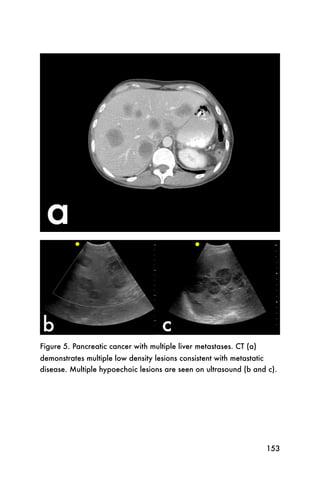 Figure 5. Pancreatic cancer with multiple liver metastases. CT (a)
demonstrates multiple low density lesions consistent with metastatic
disease. Multiple hypoechoic lesions are seen on ultrasound (b and c).




                                                                     153
 