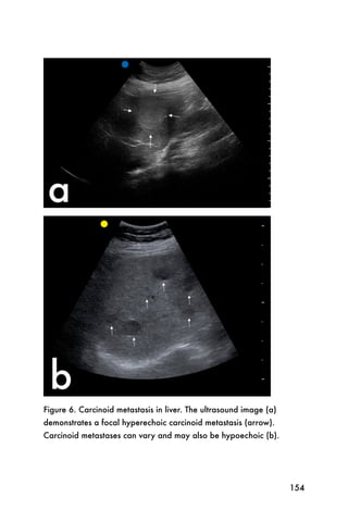 Figure 6. Carcinoid metastasis in liver. The ultrasound image (a)
demonstrates a focal hyperechoic carcinoid metastasis (arrow).
Carcinoid metastases can vary and may also be hypoechoic (b).




                                                                    154
 