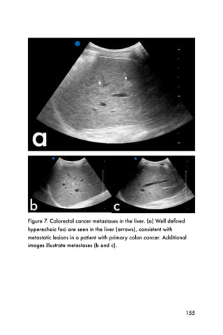 Figure 7. Colorectal cancer metastases in the liver. (a) Well deﬁned
hyperechoic foci are seen in the liver (arrows), consistent with
metastatic lesions in a patient with primary colon cancer. Additional
images illustrate metastases (b and c).




                                                                       155
 