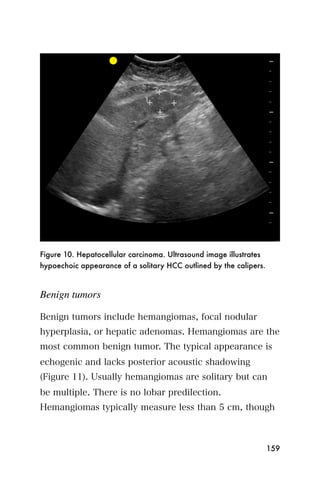 Figure 10. Hepatocellular carcinoma. Ultrasound image illustrates
hypoechoic appearance of a solitary HCC outlined by the calipers.



Benign tumors

Benign tumors include hemangiomas, focal nodular
hyperplasia, or hepatic adenomas. Hemangiomas are the
most common benign tumor. The typical appearance is
echogenic and lacks posterior acoustic shadowing
(Figure 11). Usually hemangiomas are solitary but can
be multiple. There is no lobar predilection.
Hemangiomas typically measure less than 5 cm, though



                                                                    159
 