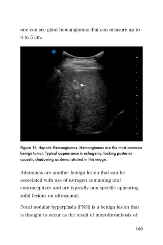 one can see giant hemangiomas that can measure up to
4 to 5 cm.




Figure 11. Hepatic Hemangiomas. Hemangiomas are the most common
benign tumor. Typical appearance is echogenic, lacking posterior
acoustic shadowing as demonstrated in this image.


Adenomas are another benign lesion that can be
associated with use of estrogen containing oral
contraceptives and are typically non-speciﬁc appearing
solid lesions on ultrasound.

Focal nodular hyperplasia (FNH) is a benign lesion that
is thought to occur as the result of microthrombosis of


                                                            160
 