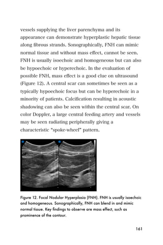 vessels supplying the liver parenchyma and its
appearance can demonstrate hyperplastic hepatic tissue
along ﬁbrous strands. Sonographically, FNH can mimic
normal tissue and without mass eﬀect, cannot be seen.
FNH is usually isoechoic and homogeneous but can also
be hypoechoic or hyperechoic. In the evaluation of
possible FNH, mass eﬀect is a good clue on ultrasound
(Figure 12). A central scar can sometimes be seen as a
typically hypoechoic focus but can be hyperechoic in a
minority of patients. Calciﬁcation resulting in acoustic
shadowing can also be seen within the central scar. On
color Doppler, a large central feeding artery and vessels
may be seen radiating peripherally giving a
characteristic spoke-wheel pattern.




Figure 12. Focal Nodular Hyperplasia (FNH). FNH is usually isoechoic
and homogeneous. Sonographically, FNH can blend in and mimic
normal tissue. Key ﬁndings to observe are mass effect, such as
prominence of the contour.


                                                                 161
 