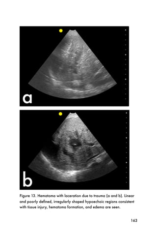 Figure 13. Hematoma with laceration due to trauma (a and b). Linear
and poorly deﬁned, irregularly shaped hypoechoic regions consistent
with tissue injury, hematoma formation, and edema are seen.


                                                                163
 