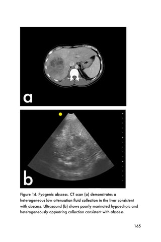 Figure 14. Pyogenic abscess. CT scan (a) demonstrates a
heterogeneous low attenuation ﬂuid collection in the liver consistent
with abscess. Ultrasound (b) shows poorly marinated hypoechoic and
heterogeneously appearing collection consistent with abscess.


                                                                        165
 