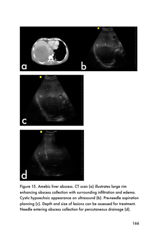 Figure 15. Amebic liver abscess. CT scan (a) illustrates large rim
enhancing abscess collection with surrounding inﬁltration and edema.
Cystic hypoechoic appearance on ultrasound (b). Pre-needle aspiration
planning (c). Depth and size of lesions can be assessed for treatment.
Needle entering abscess collection for percutaneous drainage (d).


                                                                     166
 