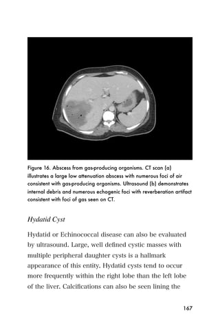 Figure 16. Abscess from gas-producing organisms. CT scan (a)
illustrates a large low attenuation abscess with numerous foci of air
consistent with gas-producing organisms. Ultrasound (b) demonstrates
internal debris and numerous echogenic foci with reverberation artifact
consistent with foci of gas seen on CT.



Hydatid Cyst

Hydatid or Echinococcal disease can also be evaluated
by ultrasound. Large, well deﬁned cystic masses with
multiple peripheral daughter cysts is a hallmark
appearance of this entity. Hydatid cysts tend to occur
more frequently within the right lobe than the left lobe
of the liver. Calciﬁcations can also be seen lining the


                                                                   167
 
