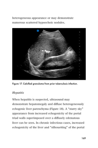 heterogeneous appearance or may demonstrate
numerous scattered hypoechoic nodules.




Figure 17. Calciﬁed granuloma from prior tuberculosis infection.



Hepatitis

When hepatitis is suspected, ultrasound may
demonstrate hepatomegaly and diﬀuse heterogeneously
echogenic liver parenchyma (Figure 18). A starry sky
appearance from increased echogenicity of the portal
triad walls superimposed over a diﬀusely edematous
liver can be seen. In chronic infectious cases, increased
echogenicity of the liver and silhouetting of the portal


                                                                   169
 
