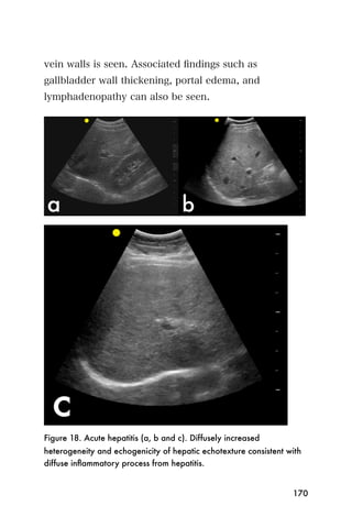 vein walls is seen. Associated ﬁndings such as
gallbladder wall thickening, portal edema, and
lymphadenopathy can also be seen.




Figure 18. Acute hepatitis (a, b and c). Diffusely increased
heterogeneity and echogenicity of hepatic echotexture consistent with
diffuse inﬂammatory process from hepatitis.


                                                                  170
 