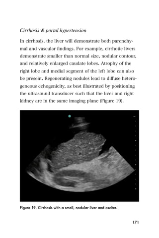 Cirrhosis & portal hypertension

In cirrhosis, the liver will demonstrate both parenchy-
mal and vascular ﬁndings. For example, cirrhotic livers
demonstrate smaller than normal size, nodular contour,
and relatively enlarged caudate lobes. Atrophy of the
right lobe and medial segment of the left lobe can also
be present. Regenerating nodules lead to diﬀuse hetero-
geneous echogenicity, as best illustrated by positioning
the ultrasound transducer such that the liver and right
kidney are in the same imaging plane (Figure 19).




Figure 19. Cirrhosis with a small, nodular liver and ascites.



                                                                171
 