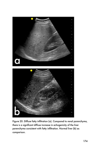 Figure 20. Diffuse fatty inﬁltration (a). Compared to renal parenchyma,
there is a signiﬁcant diffuse increase in echogenicity of the liver
parenchyma consistent with fatty inﬁltration. Normal liver (b) as
comparison.


                                                                      174
 