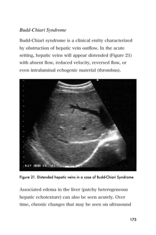 Budd-Chiari Syndrome

Budd-Chiari syndrome is a clinical entity characterized
by obstruction of hepatic vein outﬂow. In the acute
setting, hepatic veins will appear distended (Figure 21)
with absent ﬂow, reduced velocity, reversed ﬂow, or
even intraluminal echogenic material (thrombus).




Figure 21. Distended hepatic veins in a case of Budd-Chiari Syndrome


Associated edema in the liver (patchy heterogeneous
hepatic echotexture) can also be seen acutely. Over
time, chronic changes that may be seen on ultrasound


                                                                 175
 