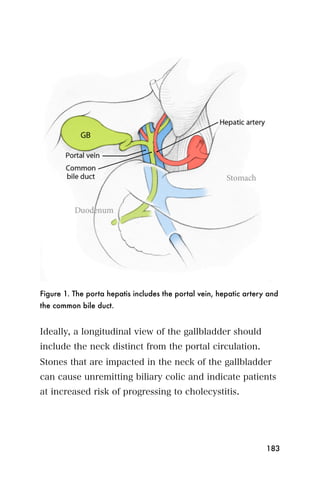 Figure 1. The porta hepatis includes the portal vein, hepatic artery and
the common bile duct.


Ideally, a longitudinal view of the gallbladder should
include the neck distinct from the portal circulation.
Stones that are impacted in the neck of the gallbladder
can cause unremitting biliary colic and indicate patients
at increased risk of progressing to cholecystitis.




                                                                    183
 