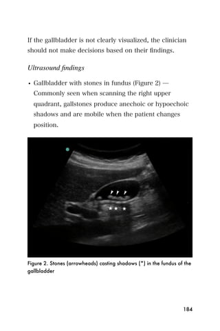 If the gallbladder is not clearly visualized, the clinician
should not make decisions based on their ﬁndings.

Ultrasound ﬁndings

• Gallbladder with stones in fundus (Figure 2) ̶
  Commonly seen when scanning the right upper
  quadrant, gallstones produce anechoic or hypoechoic
  shadows and are mobile when the patient changes
  position.




Figure 2. Stones (arrowheads) casting shadows (*) in the fundus of the
gallbladder




                                                                  184
 