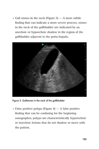 • Gall stones in the neck (Figure 3) ̶ A more subtle
  ﬁnding that can indicate a more severe process, stones
  in the neck of the gallbladder are indicated by an
  anechoic or hypoechoic shadow in the region of the
  gallbladder adjacent to the porta hepatis.




Figure 3. Gallstones in the neck of the gallbladder


• False positive polyps (Figure 4) ̶ A false positive
  ﬁnding that can be confusing for the beginning
  sonographer, polyps are characteristically hyperechoic
  or isoechoic lesions that do not shadow or move with
  the patient.



                                                        185
 