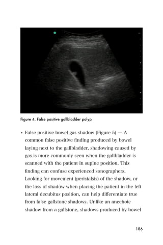 Figure 4. False positive gallbladder polyp


• False positive bowel gas shadow (Figure 5) ̶ A
  common false positive ﬁnding produced by bowel
  laying next to the gallbladder, shadowing caused by
  gas is more commonly seen when the gallbladder is
  scanned with the patient in supine position. This
  ﬁnding can confuse experienced sonographers.
  Looking for movement (peristalsis) of the shadow, or
  the loss of shadow when placing the patient in the left
  lateral decubitus position, can help diﬀerentiate true
  from false gallstone shadows. Unlike an anechoic
  shadow from a gallstone, shadows produced by bowel



                                                       186
 