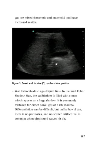 gas are mixed (isoechoic and anechoic) and have
  increased scatter.




Figure 5. Bowel wall shadow (*) can be a false positive.


• Wall Echo Shadow sign (Figure 6) ̶ In the Wall Echo
  Shadow Sign, the gallbladder is ﬁlled with stones
  which appear as a large shadow. It is commonly
  mistaken for either bowel gas or a rib shadow.
  Diﬀerentiation can be diﬃcult, but unlike bowel gas,
  there is no peristalsis, and no scatter artifact that is
  common when ultrasound waves hit air.




                                                             187
 