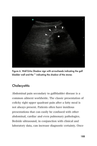 Figure 6. Wall Echo Shadow sign with arrowheads indicating the gall
bladder wall and the * indicating the shadow of the stones




Cholecystitis

Abdominal pain secondary to gallbladder disease is a
common ailment worldwide. The classic presentation of
colicky right upper quadrant pain after a fatty meal is
not always present. Patients often have insidious
presentations that can easily be confused with other
abdominal, cardiac and even pulmonary pathologies.
Bedside ultrasound, in conjunction with clinical and
laboratory data, can increase diagnostic certainty. Once


                                                                 188
 