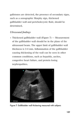 gallstones are detected, the presence of secondary signs,
such as a sonographic Murphy sign, thickened
gallbladder wall and pericholecystic ﬂuid, should be
determined.

Ultrasound ﬁndings

• Thickened gallbladder wall (Figure 7) ̶ Measurement
  of the gallbladder wall should be in the plane of the
  ultrasound beam. The upper limit of gallbladder wall
  thickness is 3-4 mm. Inﬂammation of the gallbladder
  causing thickening of the wall can be seen in other
  common conditions, such as hepatitis, ascites,
  congestive heart failure, and protein losing
  nephropathies.




Figure 7. Gallbladder wall thickening measured with calipers


                                                               189
 