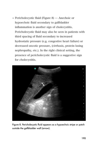 • Pericholecystic ﬂuid (Figure 8) ̶ Anechoic or
  hypoechoic ﬂuid secondary to gallbladder
  inﬂammation is another sign of cholecystitis.
  Pericholecystic ﬂuid may also be seen in patients with
  third spacing of ﬂuid secondary to increased
  hydrostatic pressure (e.g. congestive heart failure) or
  decreased oncotic pressure, (cirrhosis, protein losing
  nephropathy, etc.). In the right clinical setting, the
  presence of pericholecystic ﬂuid is a suggestive sign
  for cholecystitis.




Figure 8. Pericholecystic ﬂuid appears as a hypoechoic stripe or patch
outside the gallbladder wall (arrow).



                                                                   190
 