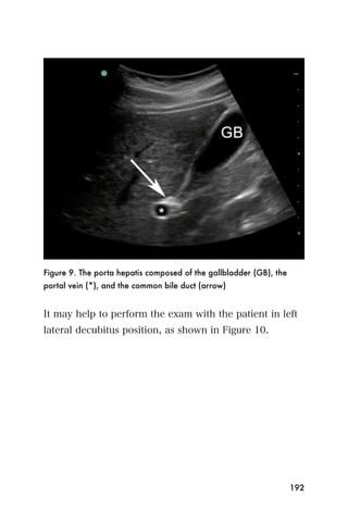 Figure 9. The porta hepatis composed of the gallbladder (GB), the
portal vein (*), and the common bile duct (arrow)


It may help to perform the exam with the patient in left
lateral decubitus position, as shown in Figure 10.




                                                                    192
 